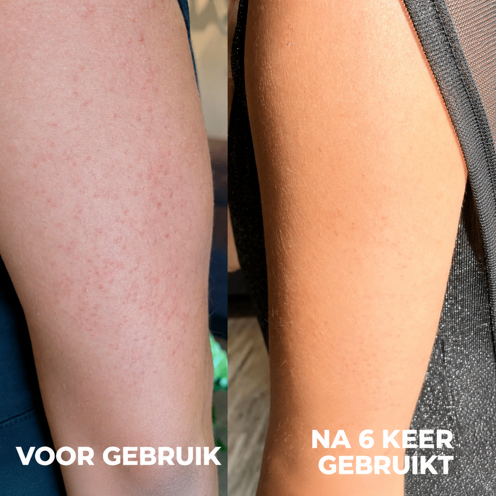 Keratosis pilaris — strawberry skin on the arm